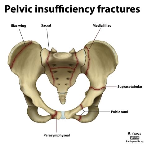 Diagram Pelvic Insufficiency Fractures Image