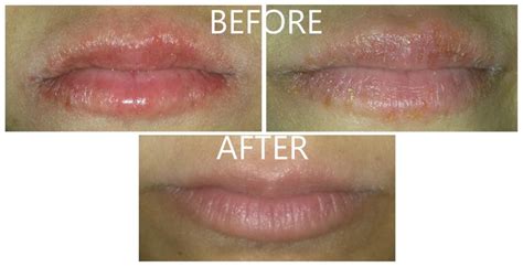 Accutane Users Amazing Cure For Cracked And Chapped Lips Page 2 Prescription Acne