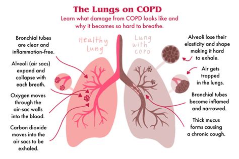 Copd Infographics