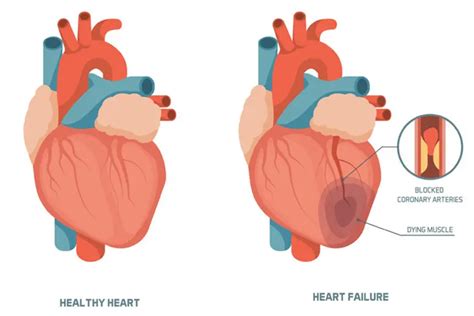 Heart Failure Symptoms And Causes Parkway East Hospital