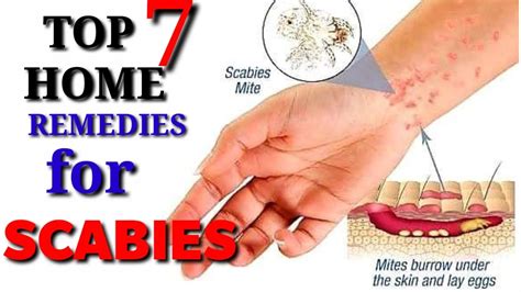 Top 7 Home Remedies For Scabies 100 Results Youtube