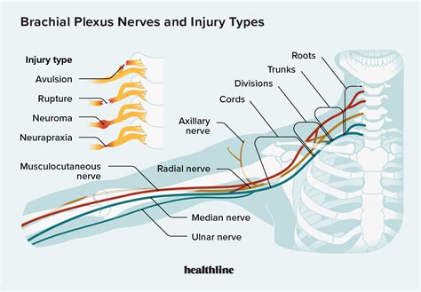 Brachial Plexus Injury Symptoms Diagnosis And Treatme