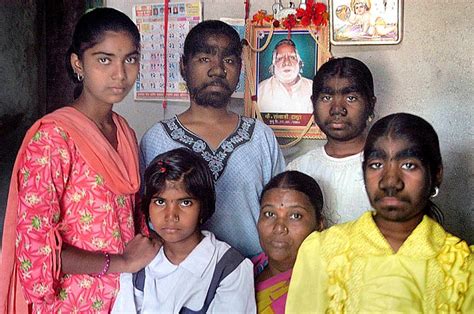 Three Indian Sisters Suffering From A Rare Genetic Disorder Werewolf Syndrome Bulawayo24 News