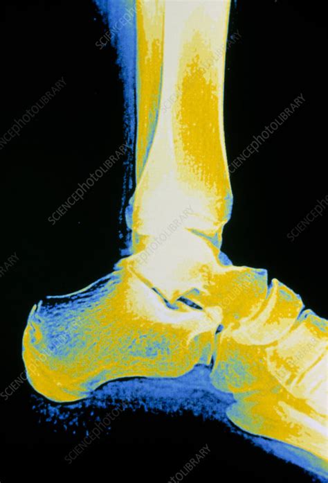 X Ray Of Ankle Bones In The Human Foot Stock Image P1160272