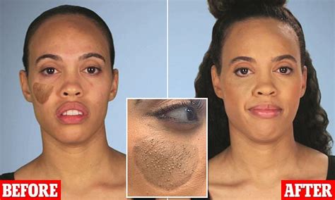 Woman 30 Reveals She Was Left With Pubic Hair Growing On Her Face After Skin Graft Daily