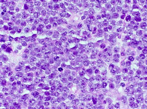 Pathology Outlines Dlbcl High Grade B Cell Lymphoma With Myc And