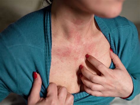 Eczema Vs Hives Similarities Differences Treatment And More
