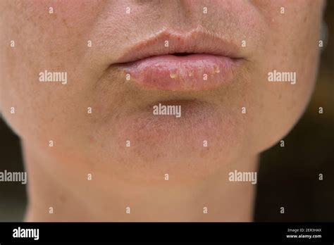 Close Up Of Female Lips Suffering From Herpes Disease Stock Photo Alamy