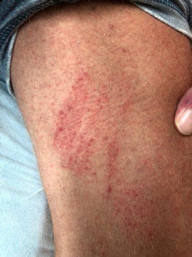 Rashes On Inner Thigh Lead To A Lot Of Itching Irritation And