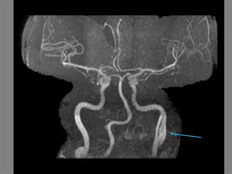 Megan S Ctmri Pathology Dissection Of Carotid Artery