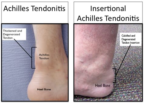 Achilles Tendinitis Cause Symptoms Diagnosis Treatment