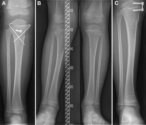 Boy 3 Years And 7 Months Old With A Greenstick Fracture Of The