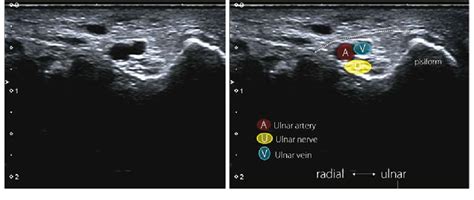 Figure 2 From Wrist Ultrasound Examination Scanning Technique And