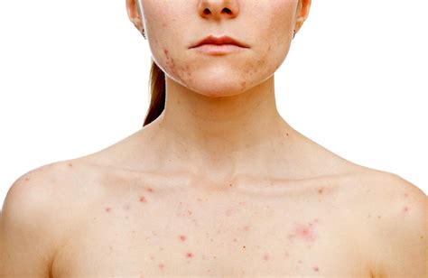 Cystic Acne Symptoms Causes Pictures And Treatment