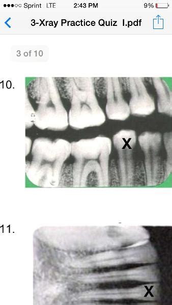Dental Assisting X Ray Quiz 1 Flashcards Easy Notecards