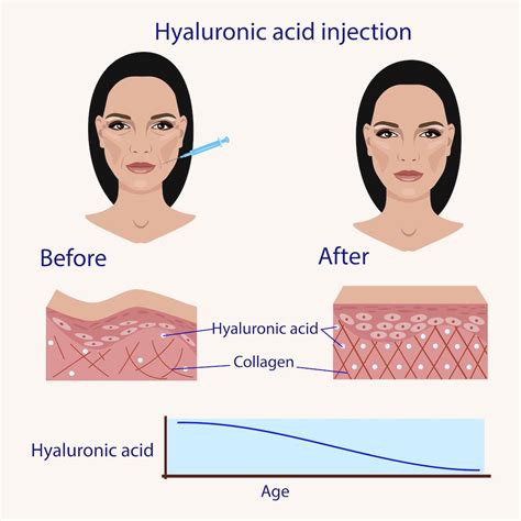 The Breakdown Of Hyaluronic Acid In Dermal Fillers And Facial Products