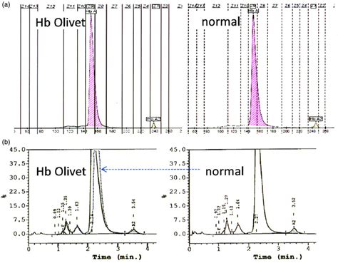 A Capillary Electrophoresis Sebia Pattern Of The Hb Olivet Carrier