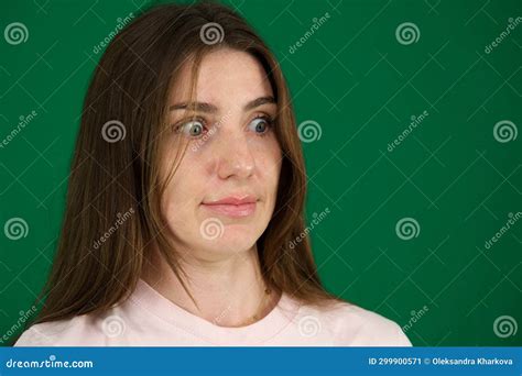 Macro Closeup Of Young Woman Face With Graveand X27s Disease