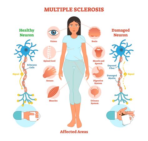 An Overview Of Multiple Sclerosis