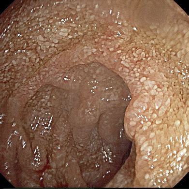 Upper Gastrointestinal Endoscopy Revealing Whitish Small Plaques Download Scientific Diagram