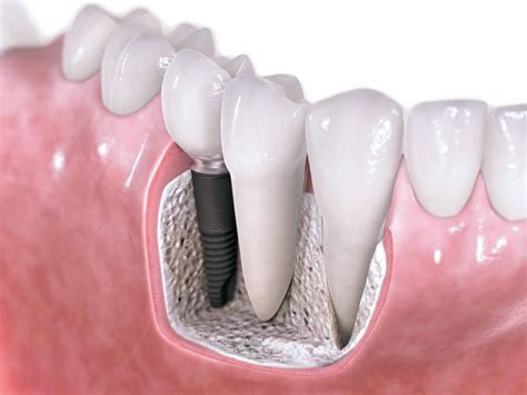 Success Rate Of Dental Implant Restoration Advanced Restorative Dentistry
