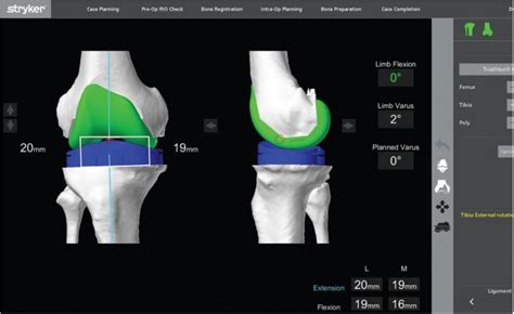 How Mako Robotic Knee Replacement Can Individualize Total And Partial