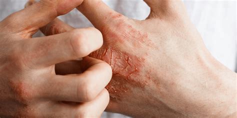 Atopic Dermatitis Treatments Slo Ca Coastal Dermatology