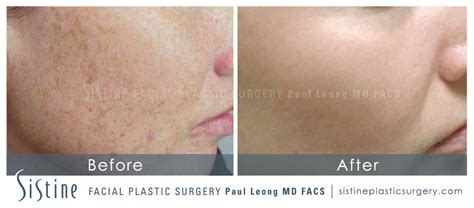 Photofacial Before And After 02 Sistine Facial Plastic Surgery