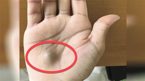 A Man Found This Strange Lump On His Palm Then A Scan Revealed The True Cause Of His Pain YouTube