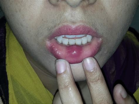 Photograph Of Cystic Swelling Lower Lip Diagnosed As Tuberculous Lesion