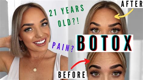 Botox Before And After Pain Results Entire Experience 😬 Youtube