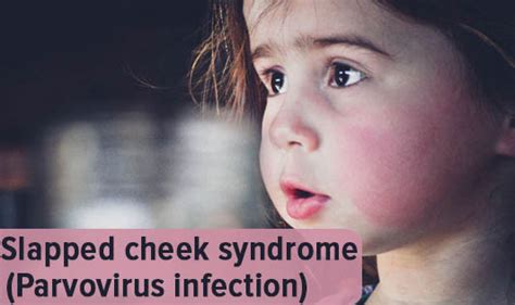 Slapped Cheek Syndrome Parvovirus Infection The Wellness Corner