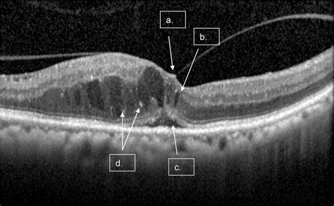 A Single Scan With Macular Fluid And Diffuse Retina Edema Arrows