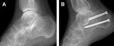 Corrective Osteotomies for Malunited Tongue-Type Calcaneal ...