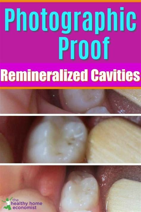 photographic proof that cavities heal heal cavities cavities healthy