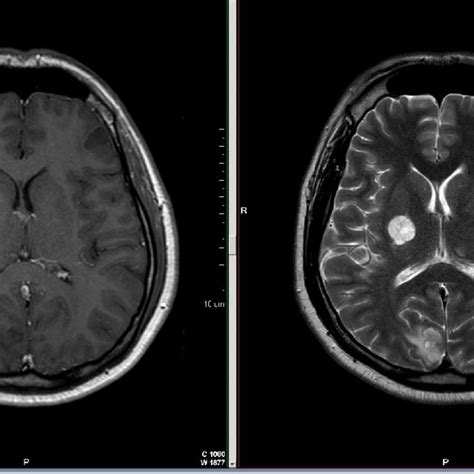 Axial T1 Post Gadolinium A And Axial T2 B Mri Demonstrating