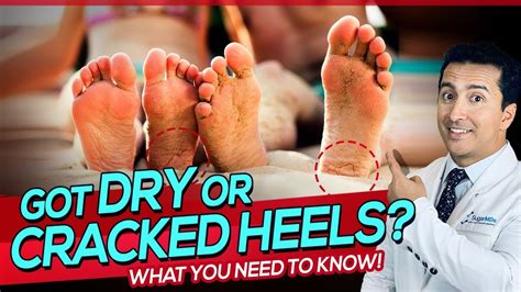 A Diabetic Skin Problem Dry Cracked Heels Causes And Remedies Youtube