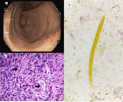 Sarcoidosis Steroids And Strongyloides—whats The Catch Clinical