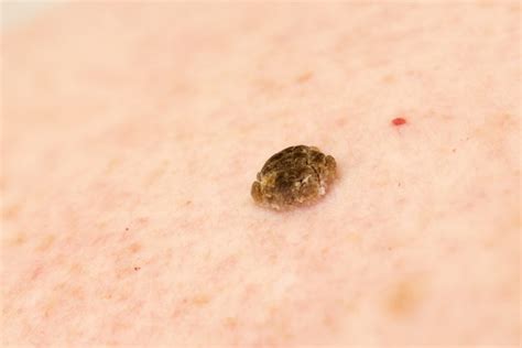 Seborrheic Keratosis Also Known As Seborrheic Verruca Or A Senile Wart