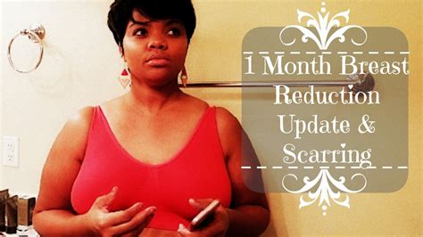 Breast Reduction Update 1 Month Post Op Scars Youtube