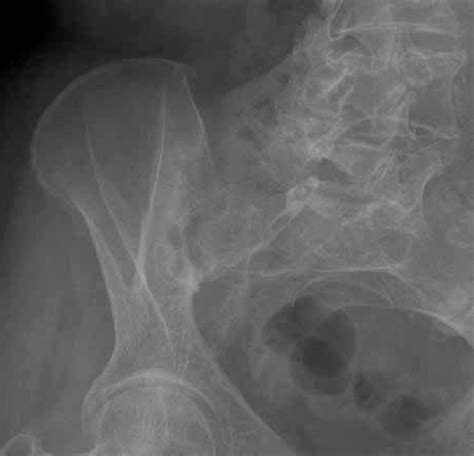 Sacroiliac Joint X Ray View