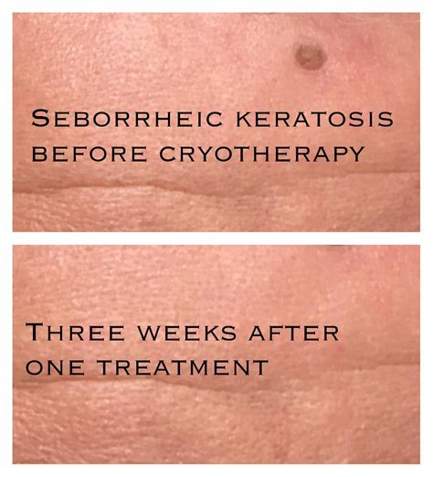 Seborrhoeic Keratosis Wart Removal At Cheshire Lasers Middlewich