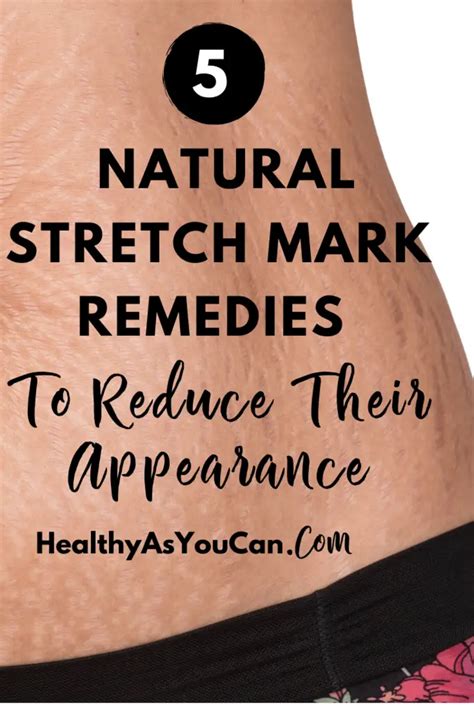 Stretch Mark At Home Remedies 5 Awesome Products To Help You Reduce Their Appearance Healthy