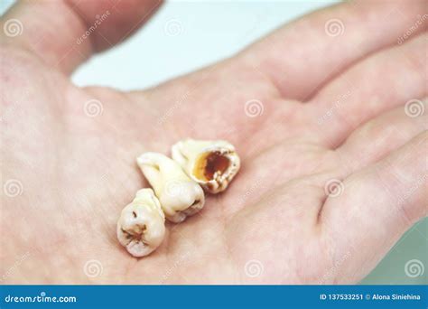 Removed Wisdom Tooth On White Stock Image Image Of Implant Close