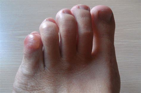 Pinky Toe Blisters Causes And Prevention Blister Prevention