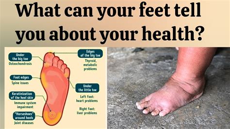 What Can Your Feet Tell You About Your Health Health Is The 458