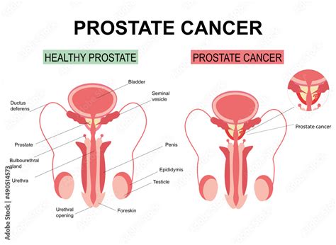 Prostate Cancer On White Background Illustration Anatomy Of The Male Reproductive Organs