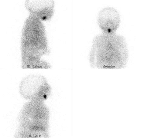 Thyroid hormones, including synthroid, should not be used either alone or in combination with in patients with normal thyroid levels, doses of synthroid used daily for hormone replacement are. Nuclear Medicine & PET: Thyroid scintigraphy: Paediatric