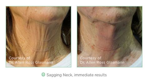 Pdo Thread Lift Neck Before And After Rentlasopa