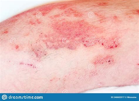 Acute Psoriasis On The Stomach In A Man Severe Redness On The Skin An